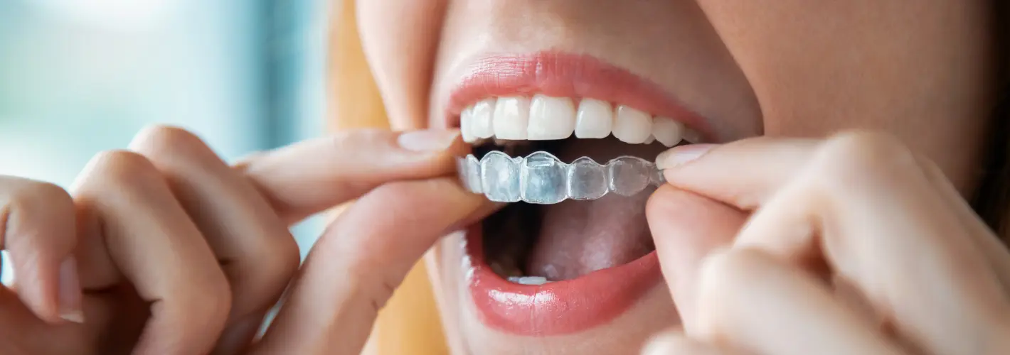 Best Custom Mouthguards Treatments Pune