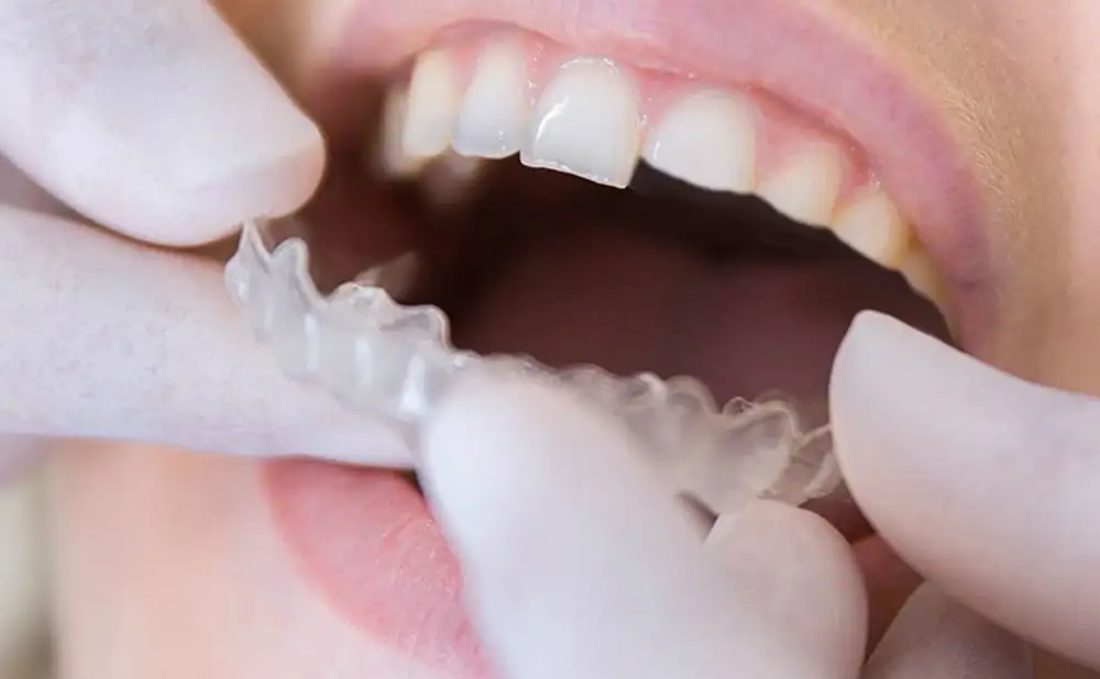 Best Bruxism Treatment in Pune