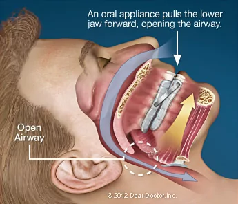 Best Sleep Apnea & TMJ Treatment in Pune 
